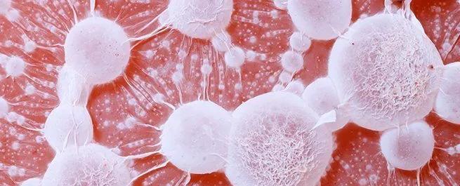 Cancer du sein : comprendre la formation des métastases