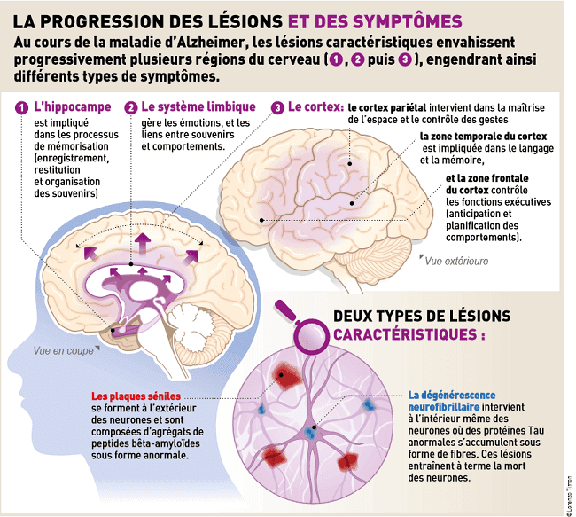 Progression de la maladie d'Alzheimer