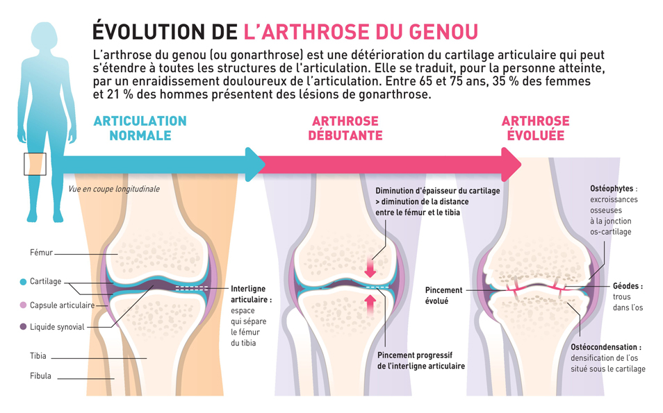 L'arthrose du genou ou la gonarthrose - Clinique du genou